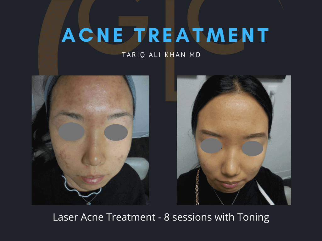 Gentle Care Laser Tustin Before and After picture - Acne Laser treatment